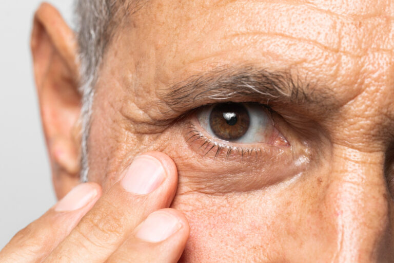 Síntomas de cataratas en adultos mayores: cómo detectarlas a tiempo 